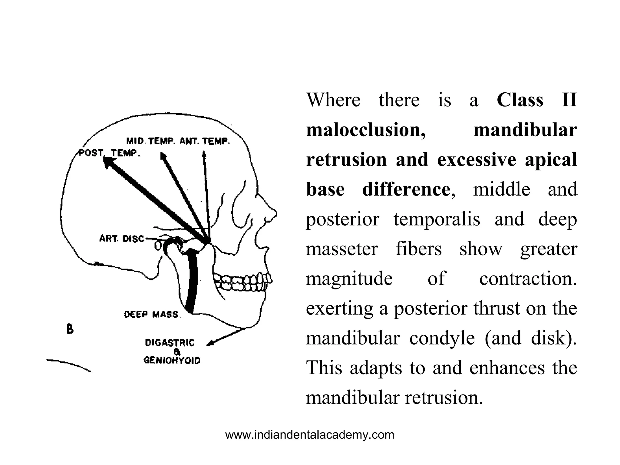 Where there is a Class II
malocclusion, mandibular
retrusion and excessive apical
base difference, middle and
posterior temporalis and deep
masseter fibers show greater
magnitude of contraction.
exerting a posterior thrust on the
mandibular condyle (and disk).
This adapts to and enhances the
mandibular retrusion.
www.indiandentalacademy.com
 