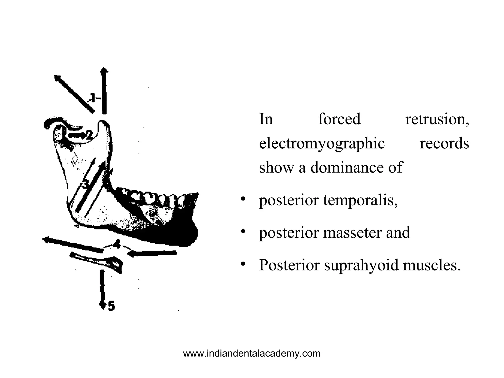 In forced retrusion,
electromyographic records
show a dominance of
• posterior temporalis,
• posterior masseter and
• Posterior suprahyoid muscles.
www.indiandentalacademy.com
 