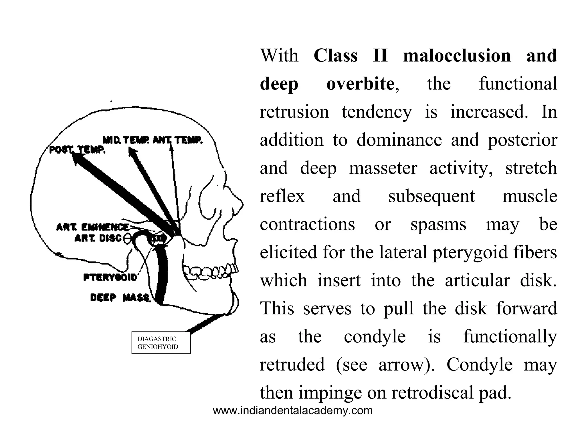 With Class II malocclusion and
deep overbite, the functional
retrusion tendency is increased. In
addition to dominance and posterior
and deep masseter activity, stretch
reflex and subsequent muscle
contractions or spasms may be
elicited for the lateral pterygoid fibers
which insert into the articular disk.
This serves to pull the disk forward
as the condyle is functionally
retruded (see arrow). Condyle may
then impinge on retrodiscal pad.
DIAGASTRIC
GENIOHYOID
www.indiandentalacademy.com
 