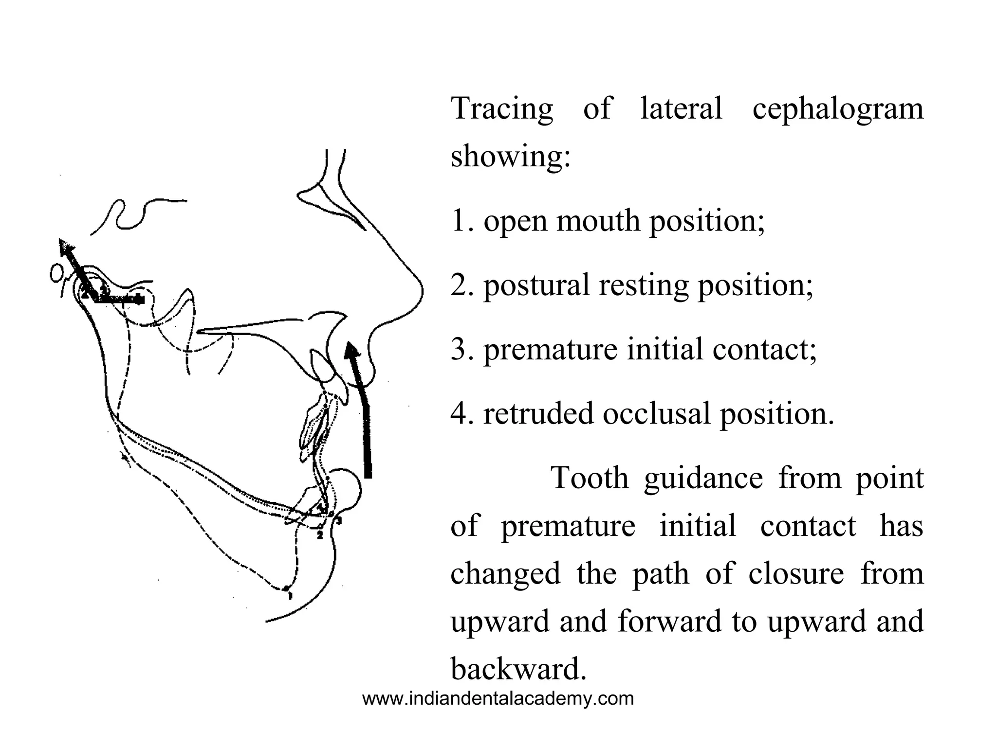 Tracing of lateral cephalogram
showing:
1. open mouth position;
2. postural resting position;
3. premature initial contact;
4. retruded occlusal position.
Tooth guidance from point
of premature initial contact has
changed the path of closure from
upward and forward to upward and
backward.
www.indiandentalacademy.com
 