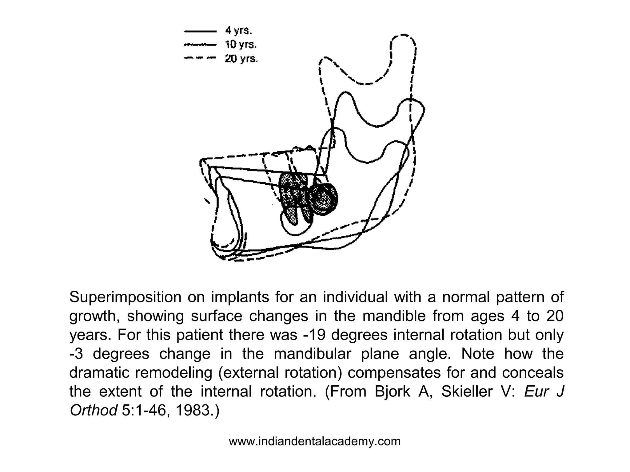 Superimposition on implants for an individual with a normal pattern of
growth, showing surface changes in the mandible from ages 4 to 20
years. For this patient there was -19 degrees internal rotation but only
-3 degrees change in the mandibular plane angle. Note how the
dramatic remodeling (external rotation) compensates for and conceals
the extent of the internal rotation. (From Bjork A, Skieller V: Eur J
Orthod 5:1-46, 1983.)
www.indiandentalacademy.com
 