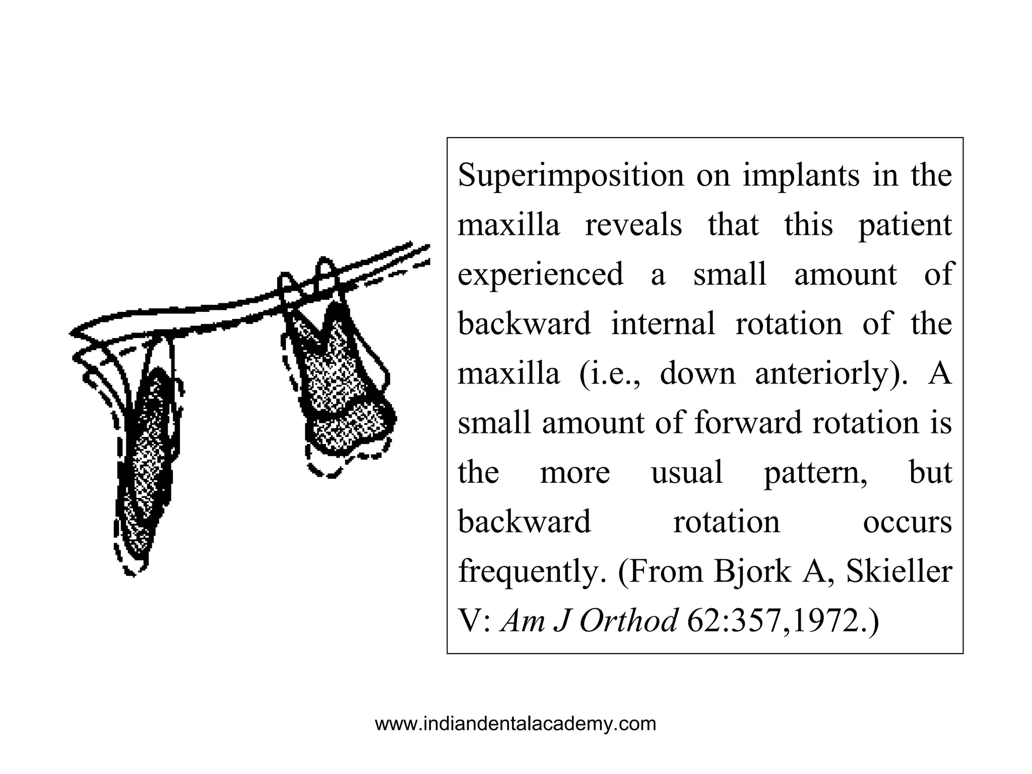 Superimposition on implants in the
maxilla reveals that this patient
experienced a small amount of
backward internal rotation of the
maxilla (i.e., down anteriorly). A
small amount of forward rotation is
the more usual pattern, but
backward rotation occurs
frequently. (From Bjork A, Skieller
V: Am J Orthod 62:357,1972.)
www.indiandentalacademy.com
 