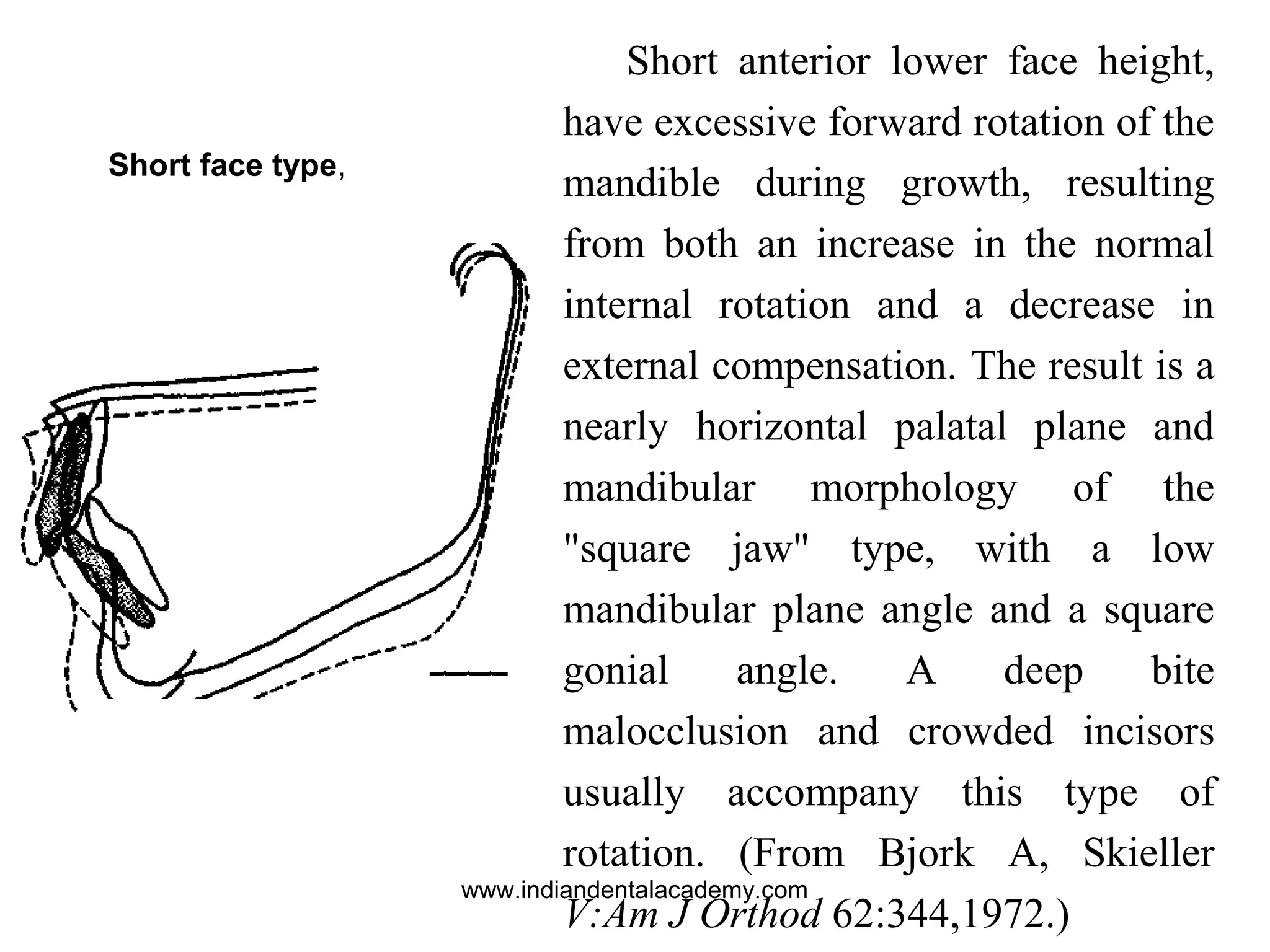 Short anterior lower face height,
have excessive forward rotation of the
mandible during growth, resulting
from both an increase in the normal
internal rotation and a decrease in
external compensation. The result is a
nearly horizontal palatal plane and
mandibular morphology of the
"square jaw" type, with a low
mandibular plane angle and a square
gonial angle. A deep bite
malocclusion and crowded incisors
usually accompany this type of
rotation. (From Bjork A, Skieller
V:Am J Orthod 62:344,1972.)
Short face type,
www.indiandentalacademy.com
 