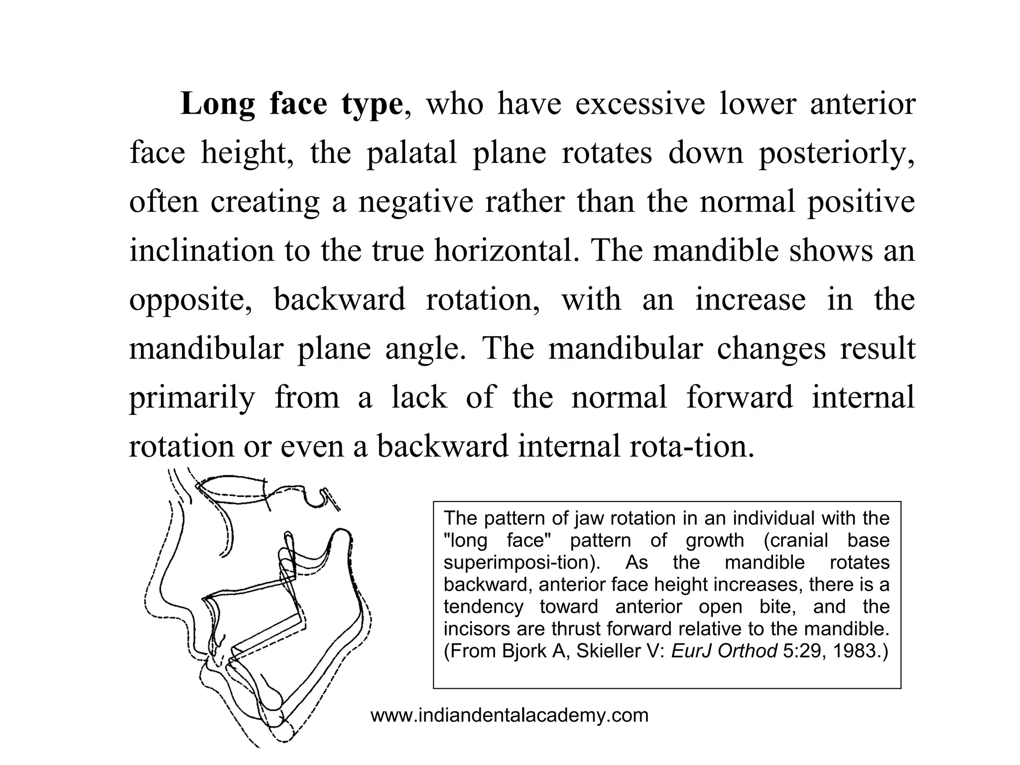 The pattern of jaw rotation in an individual with the
"long face" pattern of growth (cranial base
superimposi-tion). As the mandible rotates
backward, anterior face height increases, there is a
tendency toward anterior open bite, and the
incisors are thrust forward relative to the mandible.
(From Bjork A, Skieller V: EurJ Orthod 5:29, 1983.)
Long face type, who have excessive lower anterior
face height, the palatal plane rotates down posteriorly,
often creating a negative rather than the normal positive
inclination to the true horizontal. The mandible shows an
opposite, backward rotation, with an increase in the
mandibular plane angle. The mandibular changes result
primarily from a lack of the normal forward internal
rotation or even a backward internal rota-tion.
www.indiandentalacademy.com
 