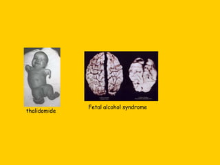 thalidomide
Fetal alcohol syndrome
 