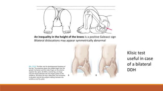 DEVELOPMENT DYSPLASIA OF THE HIP.pptx