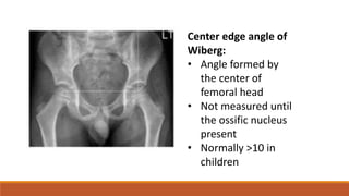 DEVELOPMENT DYSPLASIA OF THE HIP.pptx