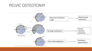 DEVELOPMENT DYSPLASIA OF THE HIP.pptx