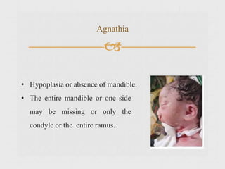 
Agnathia
• Hypoplasia or absence of mandible.
• The entire mandible or one side
may be missing or only the
condyle or the entire ramus.
 
