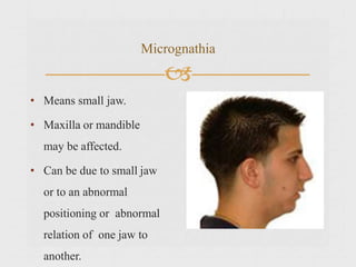 Micrognathia

• Means small jaw.
• Maxilla or mandible
may be affected.
• Can be due to small jaw
or to an abnormal
positioning or abnormal
relation of one jaw to
another.
 
