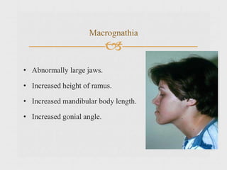 
Macrognathia
• Abnormally large jaws.
• Increased height of ramus.
• Increased mandibular body length.
• Increased gonial angle.
 