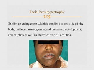 
Exhibit an enlargement which is confined to one side of the
body, unilateral macroglossia, and premature development,
and eruption as well as increased size of dentition.
Facial hemihypertrophy
 