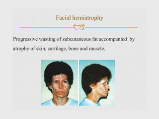 
Progressive wasting of subcutaneous fat accompanied by
atrophy of skin, cartilage, bone and muscle.
Facial hemiatrophy
 