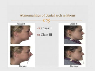 
 Class II
 Class III
Abnormalities of dental arch relations
 