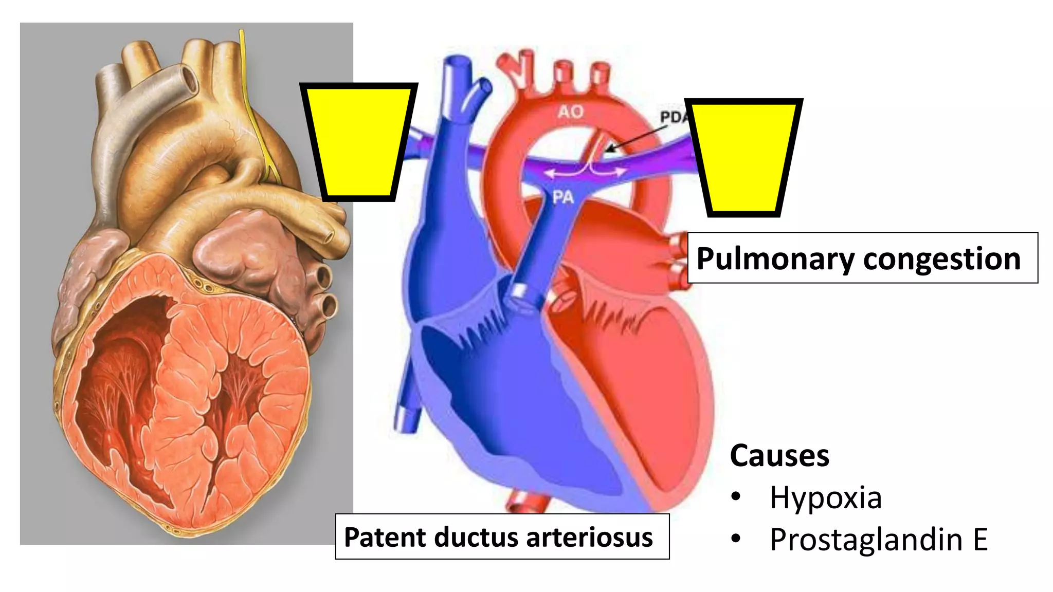 Patent ductus arteriosus
Pulmonary congestion
Causes
• Hypoxia
• Prostaglandin E
 
