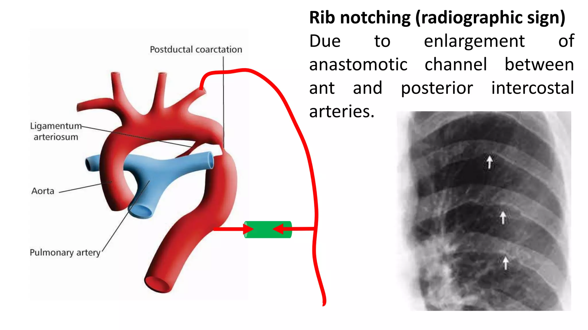 Rib notching (radiographic sign)
Due to enlargement of
anastomotic channel between
ant and posterior intercostal
arteries.
 