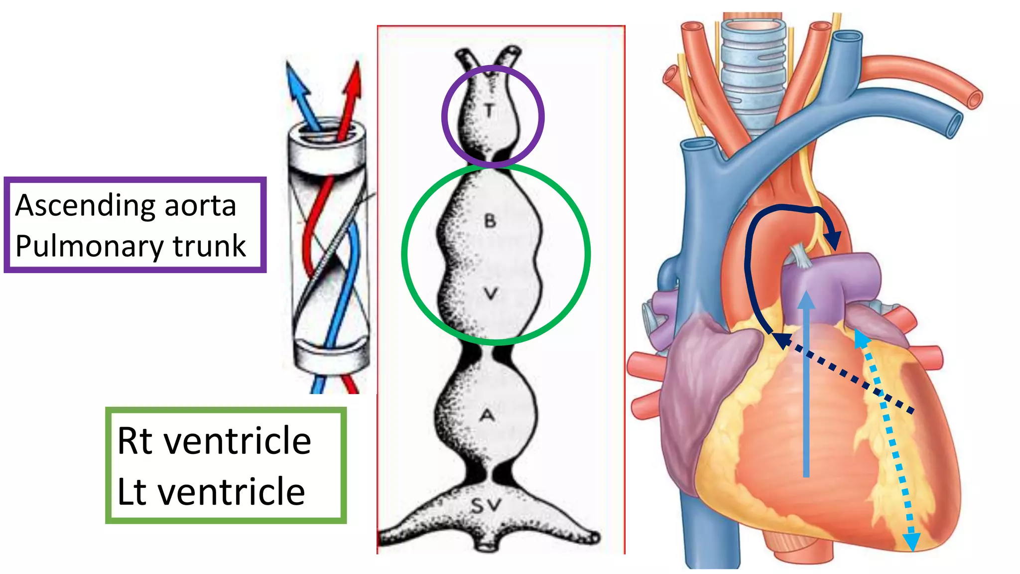 Rt ventricle
Lt ventricle
Ascending aorta
Pulmonary trunk
 