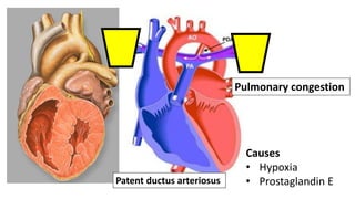Patent ductus arteriosus
Pulmonary congestion
Causes
• Hypoxia
• Prostaglandin E
 