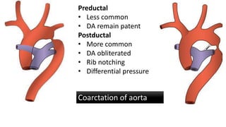 Preductal
• Less common
• DA remain patent
Postductal
• More common
• DA obliterated
• Rib notching
• Differential pressure
Coarctation of aorta
 