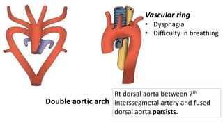 Double aortic arch
Rt dorsal aorta between 7th
interssegmetal artery and fused
dorsal aorta persists.
Vascular ring
• Dysphagia
• Difficulty in breathing
 