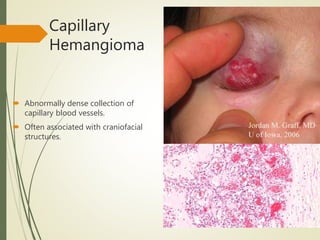 Capillary
Hemangioma
 Abnormally dense collection of
capillary blood vessels.
 Often associated with craniofacial
structures.
 