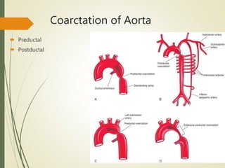 Coarctation of Aorta
 Preductal
 Postductal
 