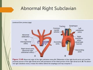 Abnormal Right Subclavian
 