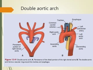Double aortic arch
 