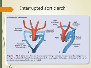 Interrupted aortic arch
 