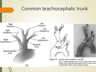 Common brachiocephalic trunk
 