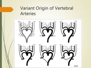 Variant Origin of Vertebral
Arteries
 
