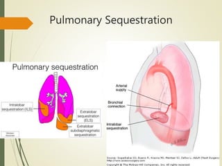Pulmonary Sequestration
 