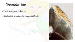 Neonatal line
• Particularly marked striae
• It reflects the metabolic changes at birth
 