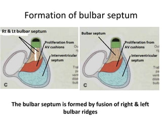 Formation of bulbar septum
The bulbar septum is formed by fusion of right & left
bulbar ridges
 