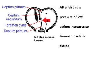 After birth the
pressure of left
atrium increases so
foramen ovale is
closed
 