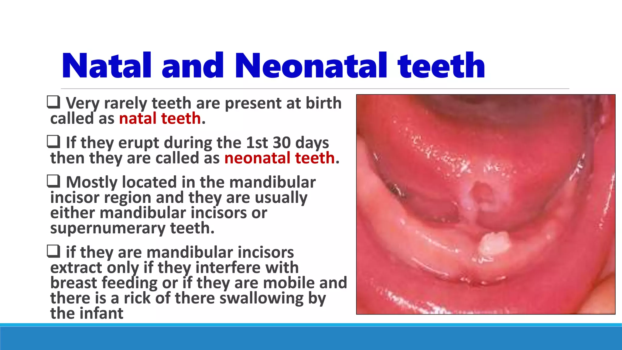 Natal and Neonatal teeth
 Very rarely teeth are present at birth
called as natal teeth.
 If they erupt during the 1st 30 days
then they are called as neonatal teeth.
 Mostly located in the mandibular
incisor region and they are usually
either mandibular incisors or
supernumerary teeth.
 if they are mandibular incisors
extract only if they interfere with
breast feeding or if they are mobile and
there is a rick of there swallowing by
the infant
 