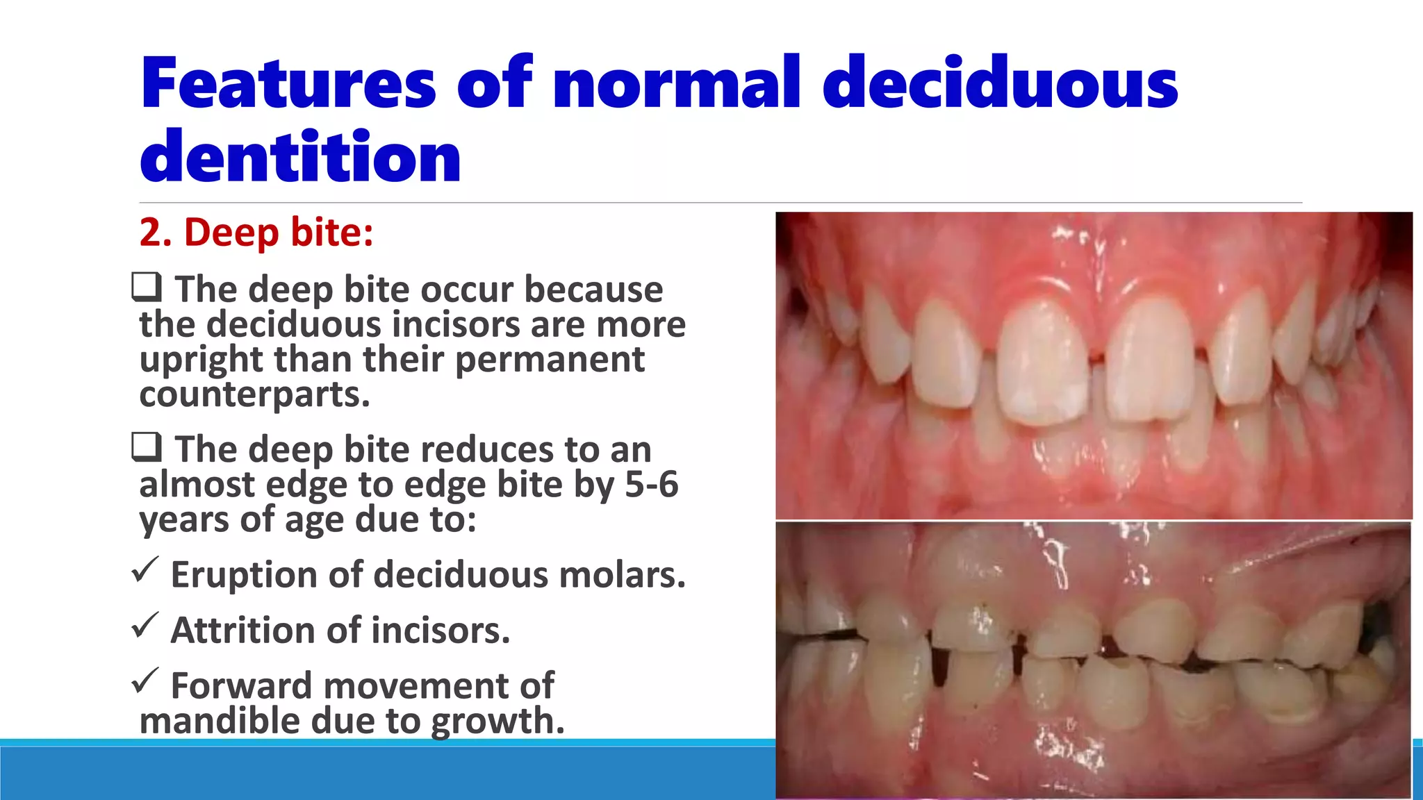 Features of normal deciduous
dentition
2. Deep bite:
 The deep bite occur because
the deciduous incisors are more
upright than their permanent
counterparts.
 The deep bite reduces to an
almost edge to edge bite by 5-6
years of age due to:
 Eruption of deciduous molars.
 Attrition of incisors.
 Forward movement of
mandible due to growth.
 
