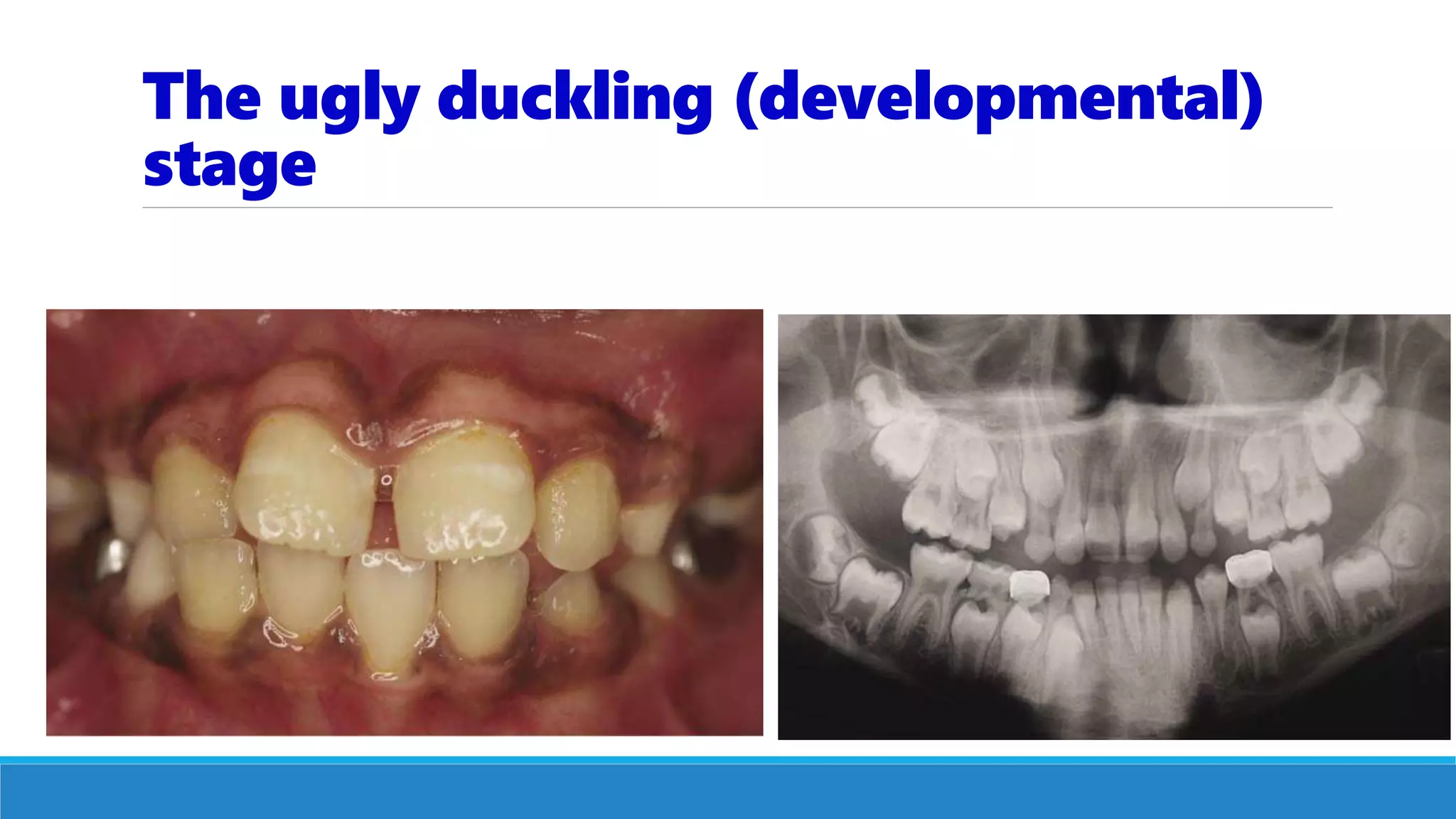 The ugly duckling (developmental)
stage
 