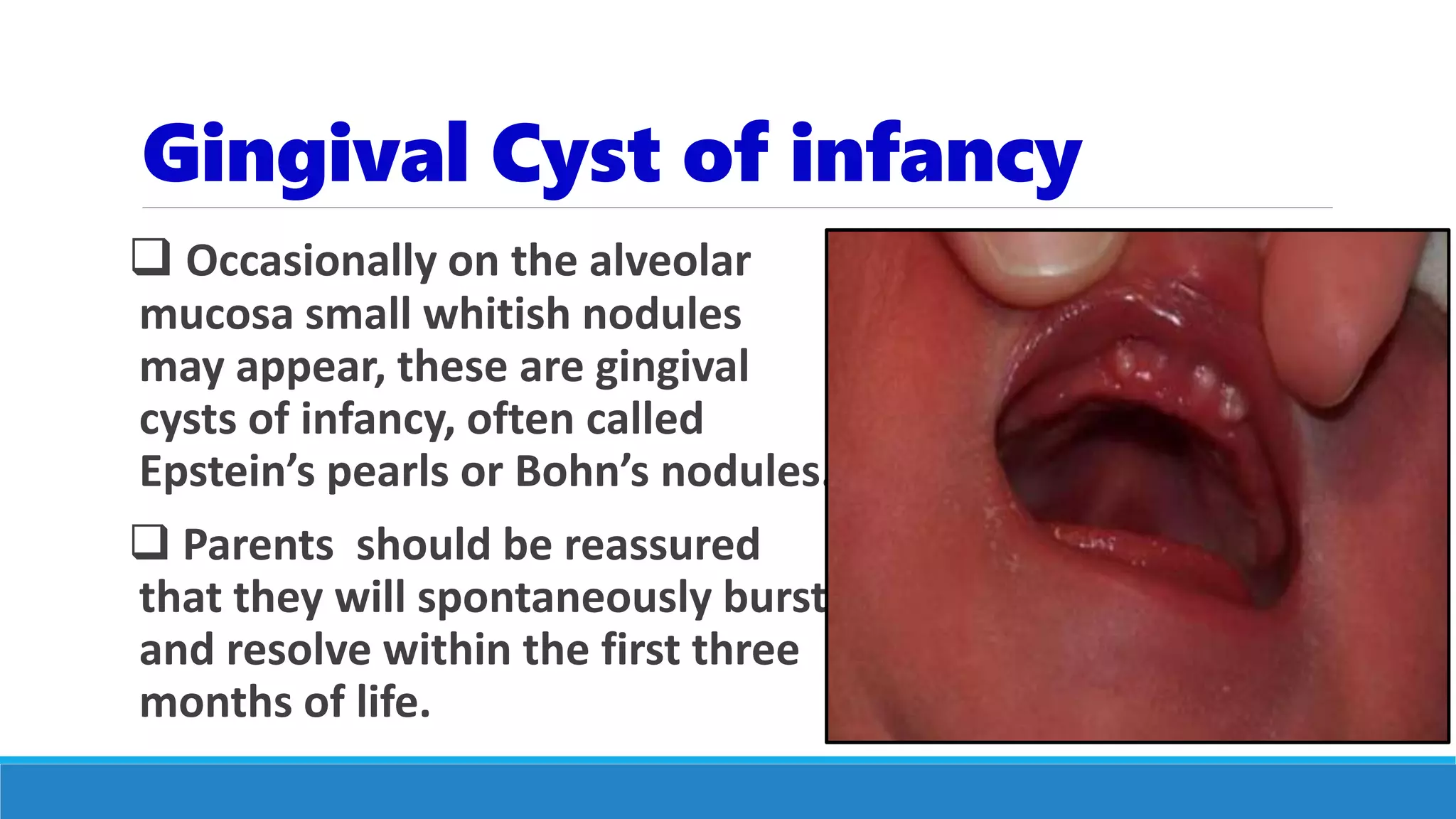 Gingival Cyst of infancy
 Occasionally on the alveolar
mucosa small whitish nodules
may appear, these are gingival
cysts of infancy, often called
Epstein’s pearls or Bohn’s nodules.
 Parents should be reassured
that they will spontaneously burst
and resolve within the first three
months of life.
 