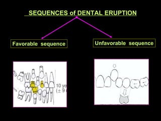 SEQUENCES of DENTAL ERUPTION



Favorable sequence




                        -345

                        -435

       ...
