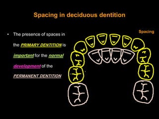 Spacing in deciduous dentition
                                            No Spacing
• Absence of spaces in the

  primar...