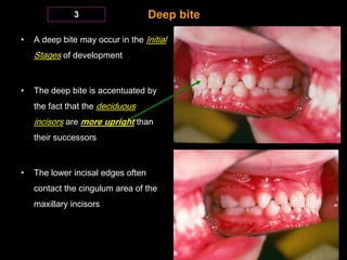 Deep bite



This deep bite is later Reduced

due to the following factors:

a. Eruption of deciduous molars

b. Attrition...