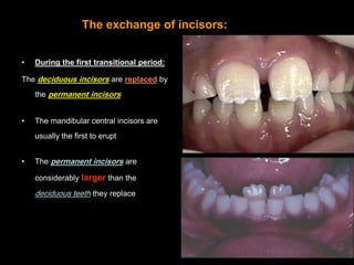 The exchange of incisors:

                               •   This difference b/w the amount of

                         ...
