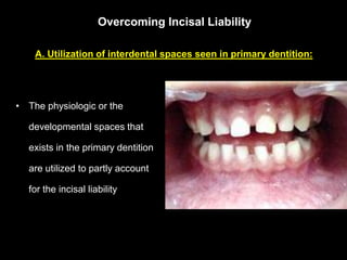 Overcoming Incisal Liability

   A. Utilization of interdental spaces seen in primary dentition:


• The Permanent Incisor...