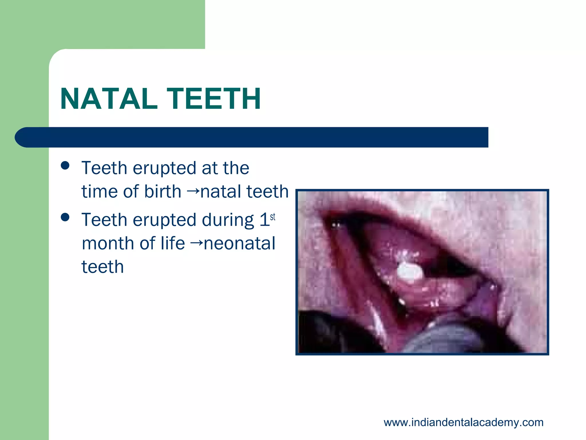 NATAL TEETH




Teeth erupted at the
time of birth →natal teeth
Teeth erupted during 1st
month of life →neonatal
teeth

www.indiandentalacademy.com

 