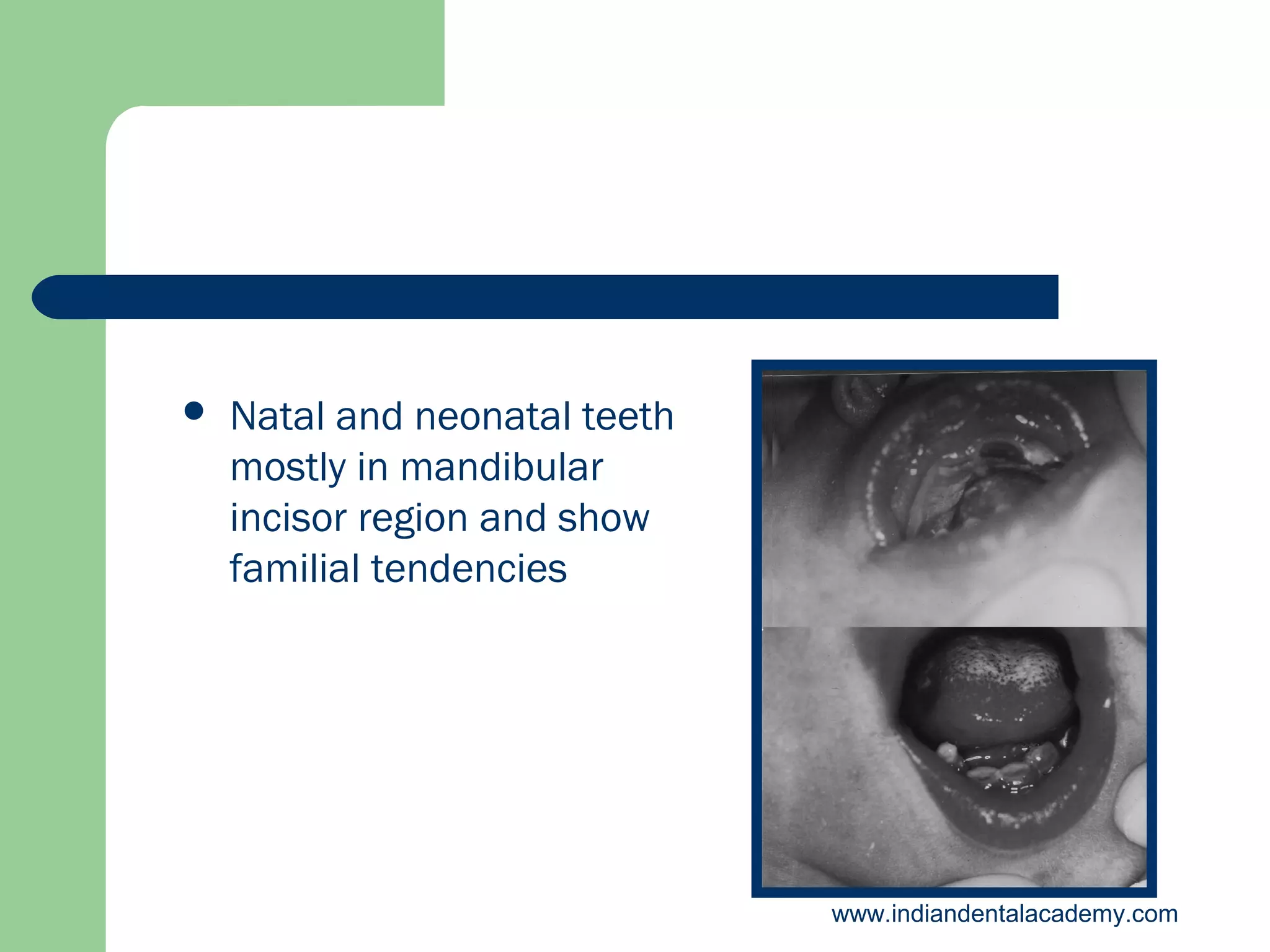 

Natal and neonatal teeth
mostly in mandibular
incisor region and show
familial tendencies

www.indiandentalacademy.com

 