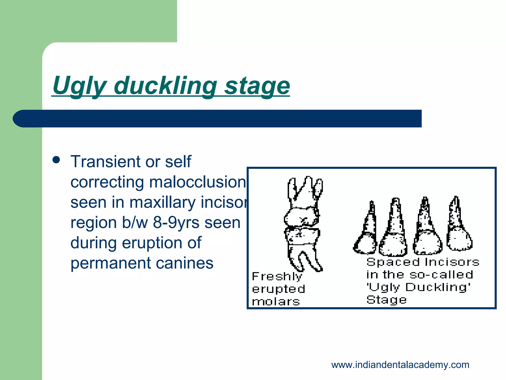 Ugly duckling stage


Transient or self
correcting malocclusion
seen in maxillary incisor
region b/w 8-9yrs seen
during eruption of
permanent canines

www.indiandentalacademy.com

 