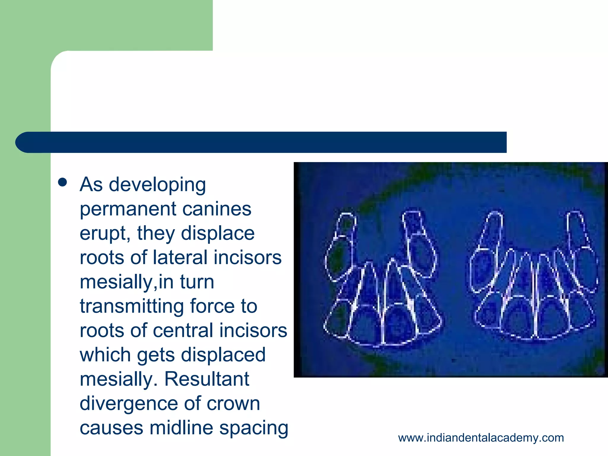 

As developing
permanent canines
erupt, they displace
roots of lateral incisors
mesially,in turn
transmitting force to
roots of central incisors
which gets displaced
mesially. Resultant
divergence of crown
causes midline spacing

www.indiandentalacademy.com

 