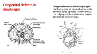 Congenital defects in
diaphragm
Congenital eventration of diaphragm:
diaphragm may be thin and aponeurotic
and may bulge upwards into the thorax.
the bulging may be unilateral or may be
confined to a smaller area.
 