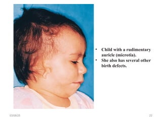 03/08/25 22
• Child with a rudimentary
auricle (microtia).
• She also has several other
birth defects.
 